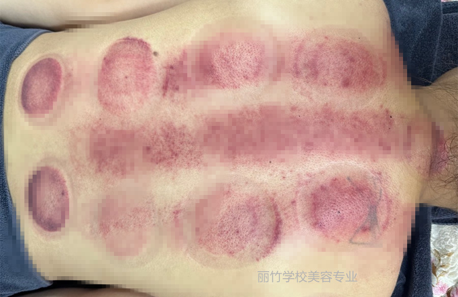 拔火罐的顏色代表什么？南寧美容美體專業(yè)實(shí)訓(xùn)